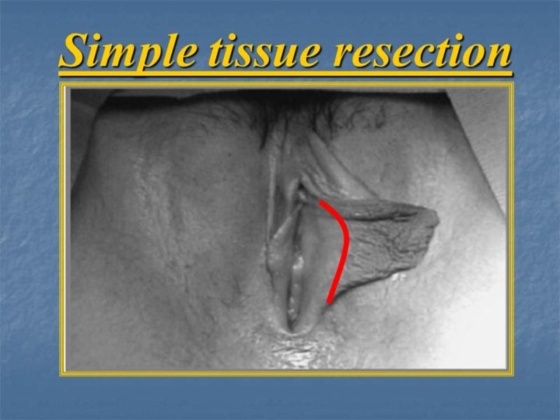 מצגת כירורגיה פלסטית של הנרתיק והפות (12)