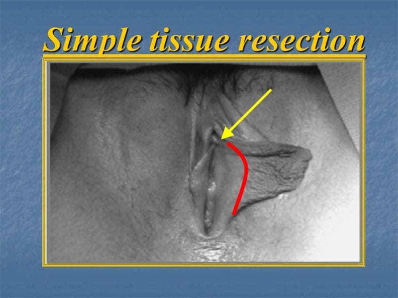 מצגת כירורגיה פלסטית של הנרתיק והפות (14)