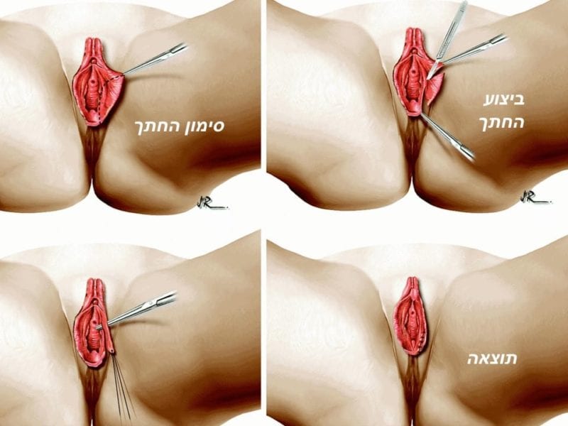 מצגת כירורגיה פלסטית של הנרתיק והפות (16)