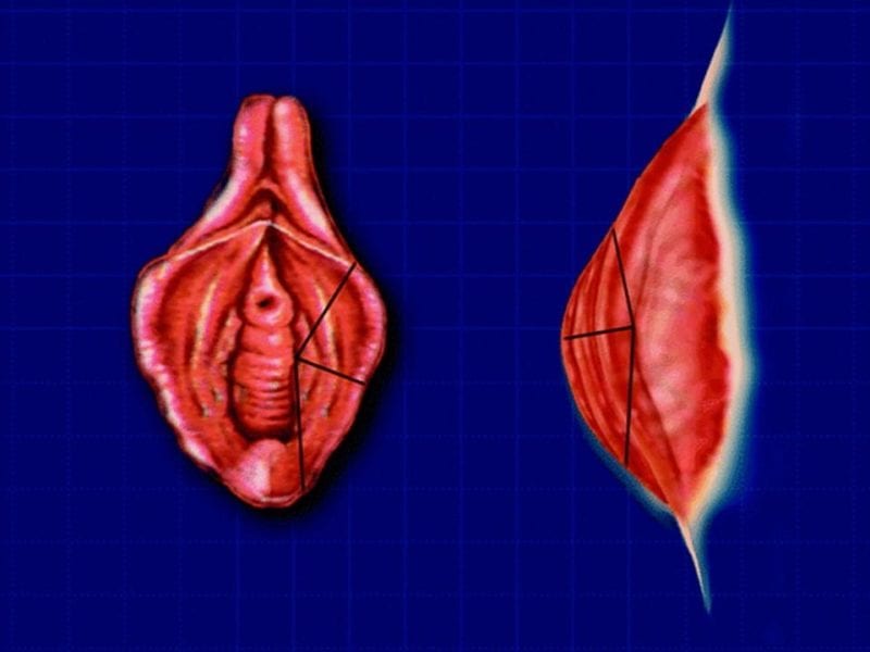 מצגת כירורגיה פלסטית של הנרתיק והפות (17)
