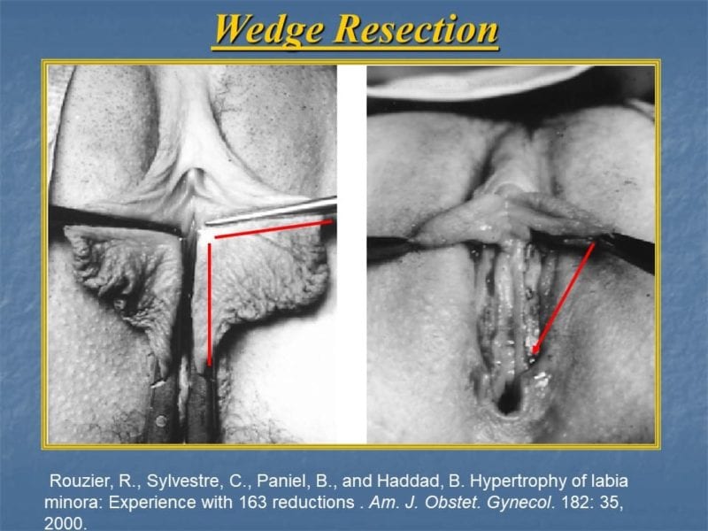 מצגת כירורגיה פלסטית של הנרתיק והפות (18)