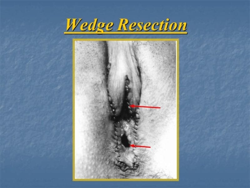 מצגת כירורגיה פלסטית של הנרתיק והפות (19)