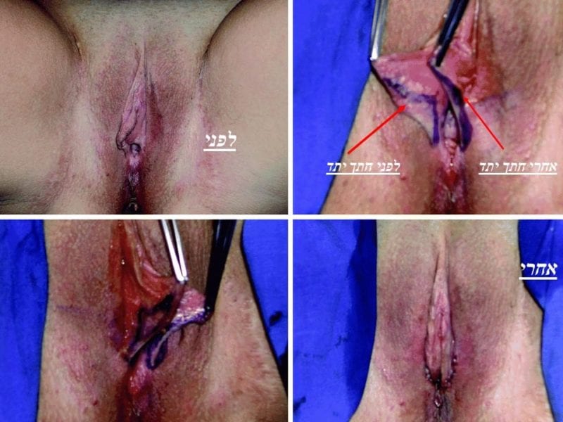 מצגת כירורגיה פלסטית של הנרתיק והפות (20)