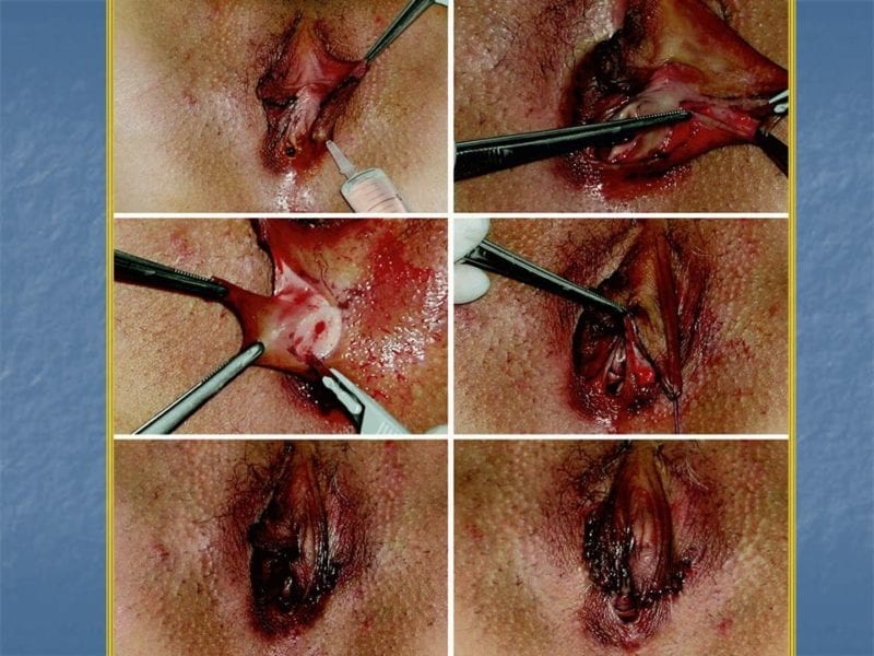 מצגת כירורגיה פלסטית של הנרתיק והפות (21)