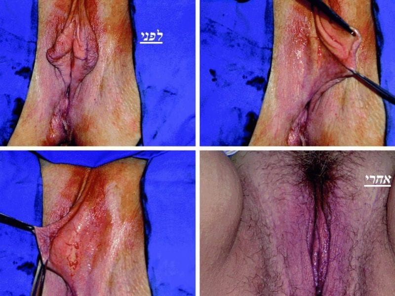 מצגת כירורגיה פלסטית של הנרתיק והפות (22)