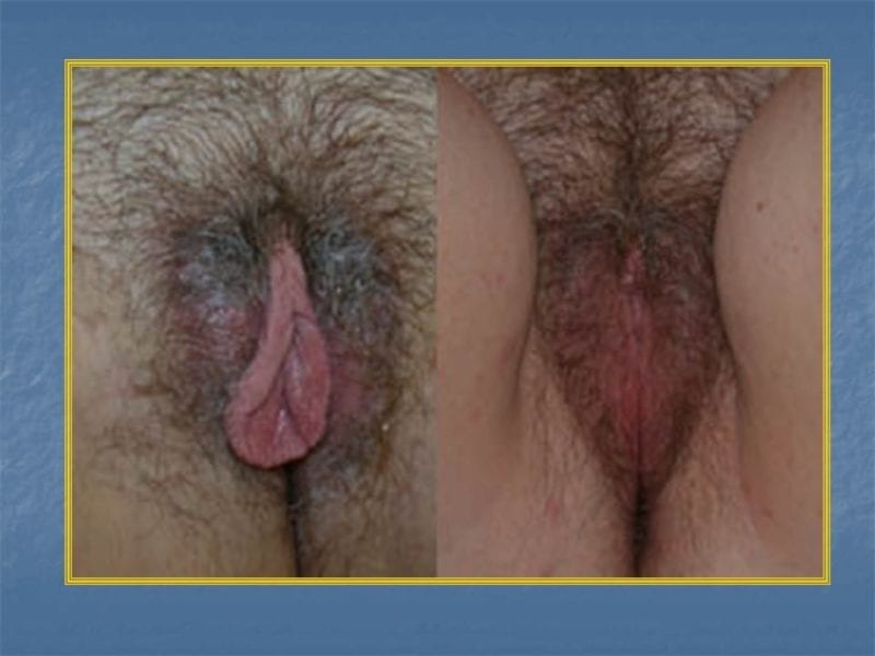 מצגת כירורגיה פלסטית של הנרתיק והפות (23)