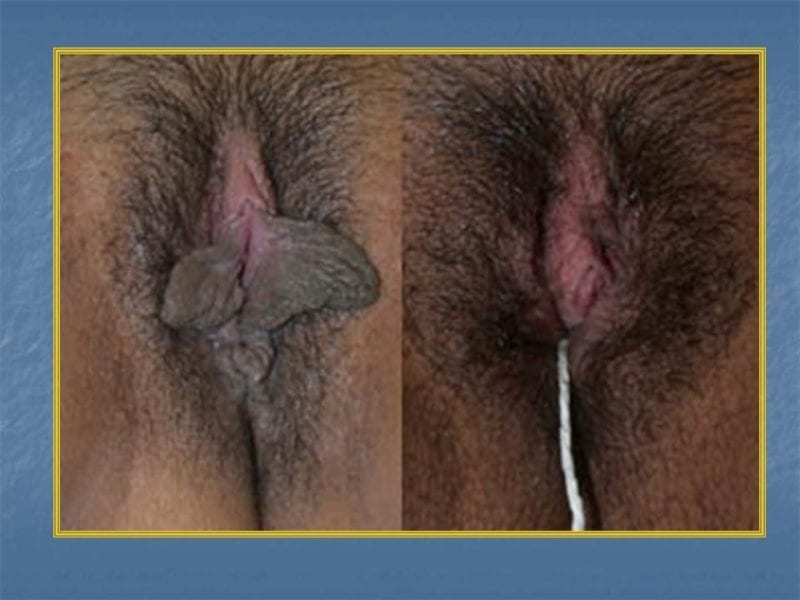 מצגת כירורגיה פלסטית של הנרתיק והפות (24)