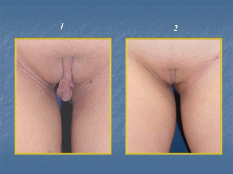 מצגת כירורגיה פלסטית של הנרתיק והפות (25)