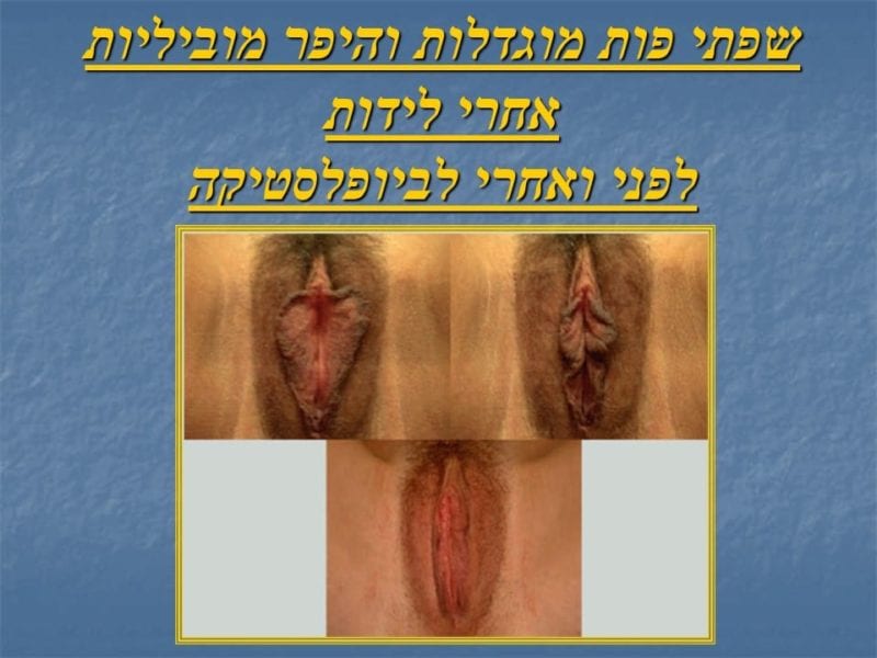 מצגת כירורגיה פלסטית של הנרתיק והפות (26)