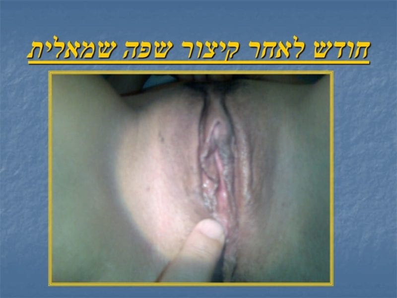 מצגת כירורגיה פלסטית של הנרתיק והפות (28)