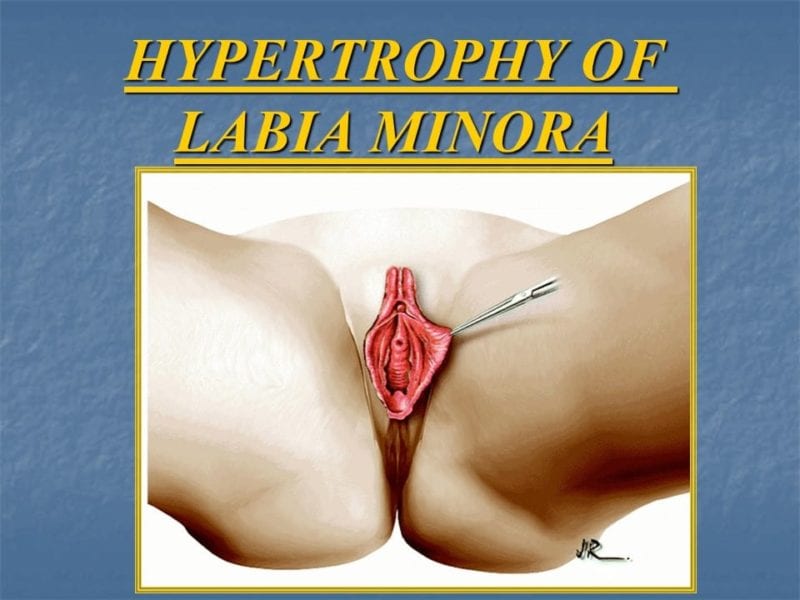 מצגת כירורגיה פלסטית של הנרתיק והפות (3)