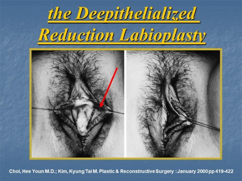 מצגת כירורגיה פלסטית של הנרתיק והפות (33)