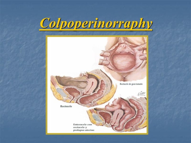 מצגת כירורגיה פלסטית של הנרתיק והפות (38)