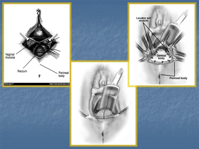מצגת כירורגיה פלסטית של הנרתיק והפות (41)