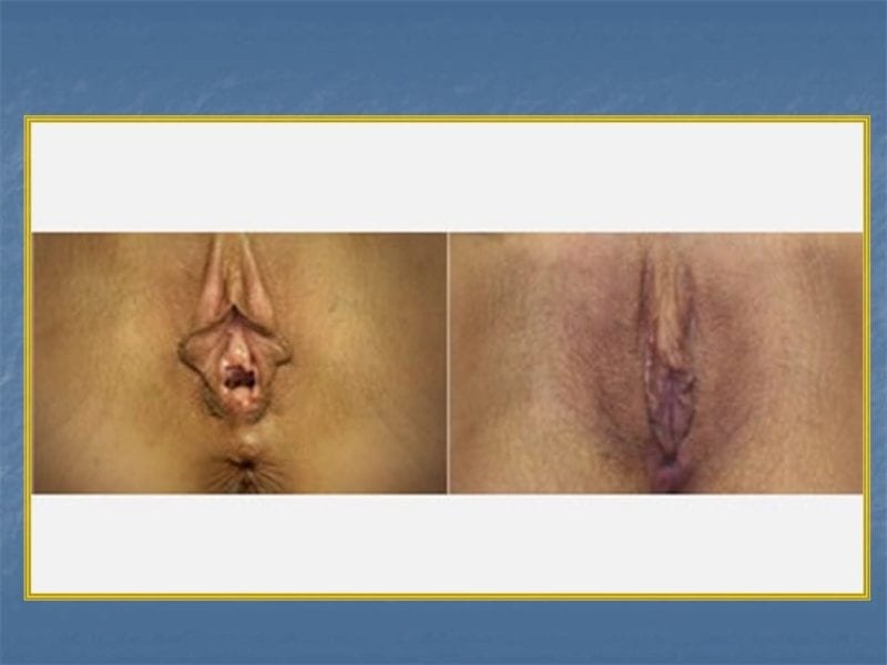 מצגת כירורגיה פלסטית של הנרתיק והפות (43)