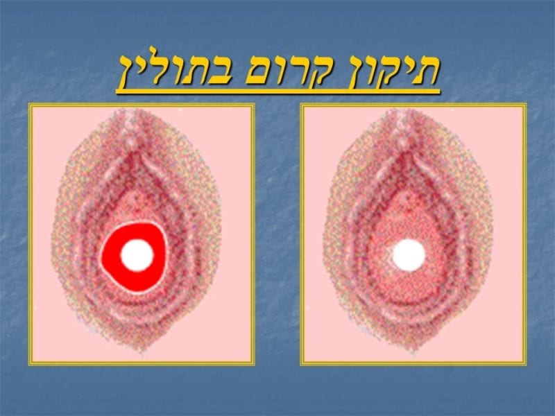 מצגת כירורגיה פלסטית של הנרתיק והפות (48)