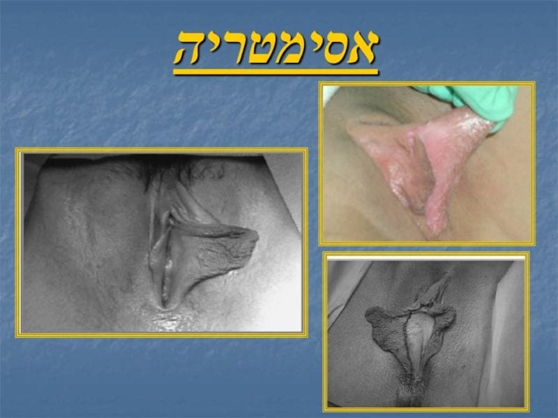 מצגת כירורגיה פלסטית של הנרתיק והפות (9)