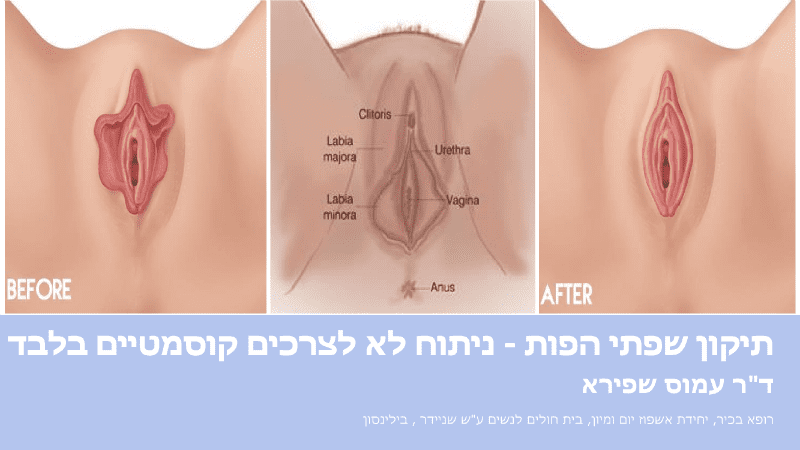 מצגת תיקון שפתי הפות (1)