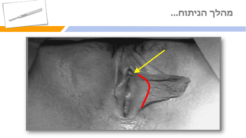 מצגת תיקון שפתי הפות (17)