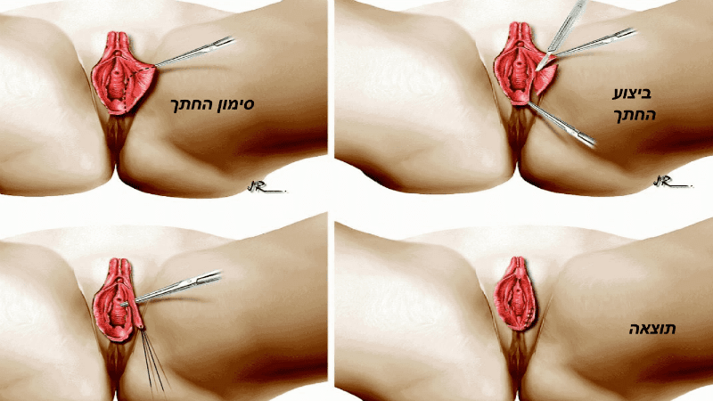מצגת תיקון שפתי הפות (18)
