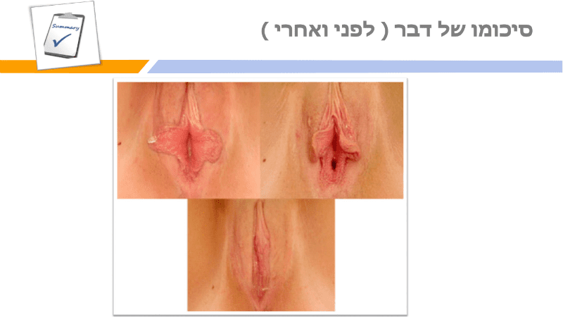 מצגת תיקון שפתי הפות (22)