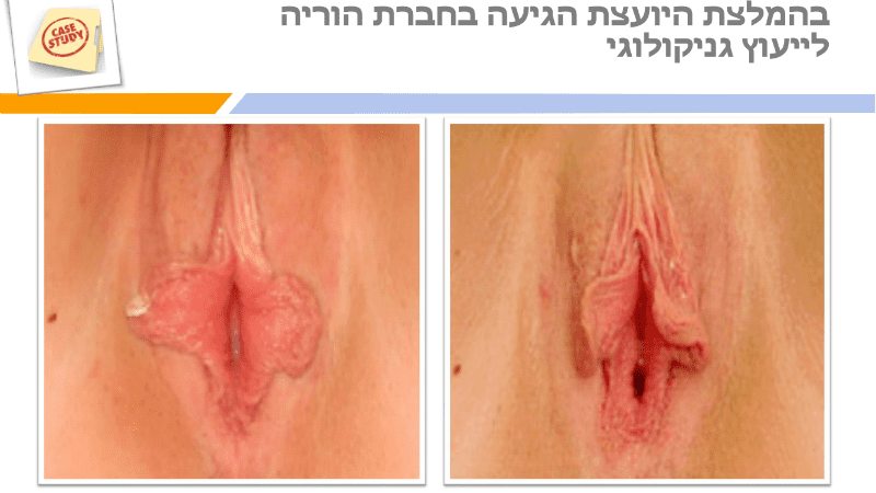 מצגת תיקון שפתי הפות (6)